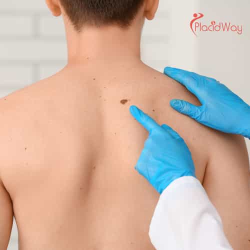 Advanced Melanoma Treatment in Tijuana - Targeting Metastasis When Standard Care Fails